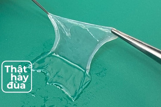 Thần kỳ: Dùng màng nhau thai phục hồi thị lực sau khi bị tạt axit