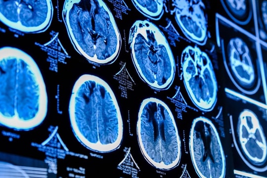 U não và ung thư não có giống nhau hay không?