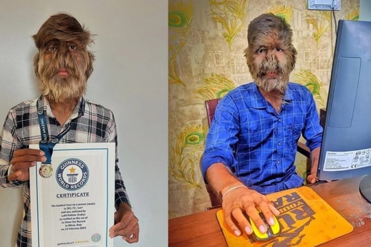 Người mắc hội chứng người sói lập kỷ lục Guinness với khuôn mặt nhiều lông nhất