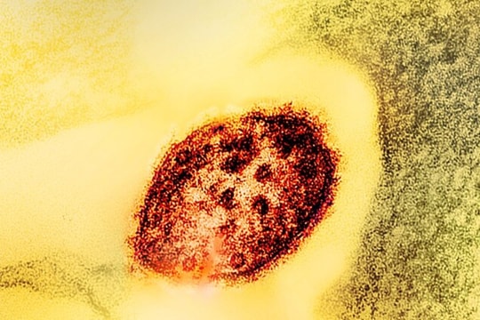 Sởi không đơn thuần là nổi mẩn đỏ mà còn gây ra những di chứng lâu dài