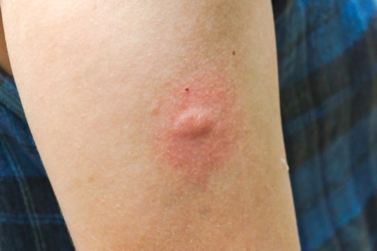 Vì sao muỗi chỉ đốt một mình bạn?