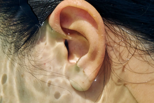 Cách để tránh bị viêm ống tai ngoài do bơi lội khi du lịch hè này