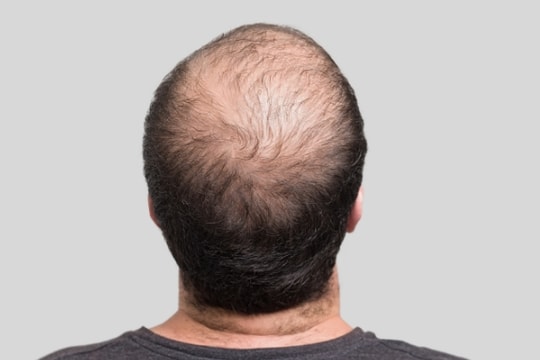 Người hói có thể mọc tóc trở lại nhờ phát hiện khoa học mới