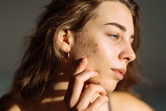 Đã trưởng thành, sao vẫn nổi mụn?