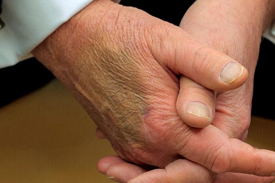 Tổng thống Donald Trump được chẩn đoán mắc suy tĩnh mạch mạn tính: Đó là bệnh gì?