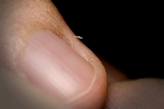 Cách tốt nhất để xử lý mảng da bong quanh móng (hangnail) là gì?