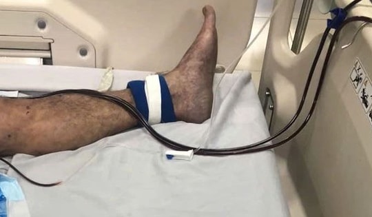 Tiếp xúc với loại thịt này, người đàn ông 61 tuổi suýt tử vong