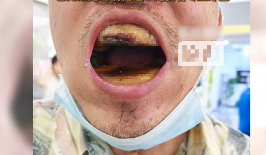 Tiếc tiền đi nha sĩ, người đàn ông tự mua nhựa trám răng rồi nhận kết cục đáng sợ