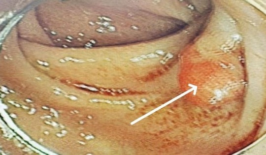 Bất ngờ "thủ phạm" khiến người phụ nữ 58 tuổi đau bụng kéo dài