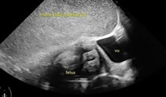 Siêu âm cho thai phụ, bác sĩ sốc nặng khi thấy thứ bên trong