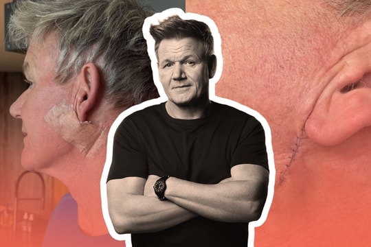 Siêu đầu bếp Gordon Ramsay tiết lộ bị mắc ung thư da