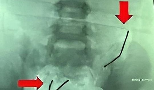 Bé trai 5 tuổi đau bụng, nôn ói, gia đình đưa đi kiểm tra thì sốc nặng