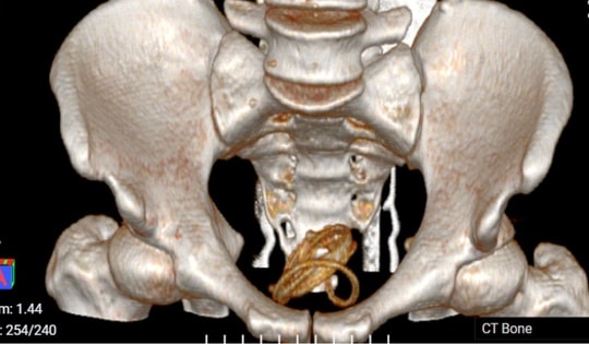 Người đàn ông 36 tuổi bị tiểu buốt, đi khám các bác sĩ phát hiện "bí mật đáng sợ"