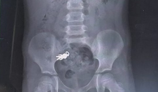 Chụp X-quang bụng bé trai 7 tuổi, bác sĩ sốc nặng khi phát hiện thứ bên trong