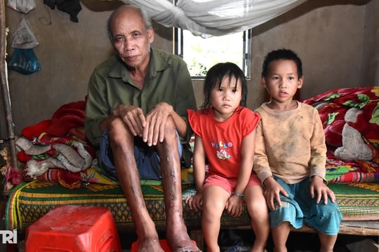 Xót cảnh người cha nghèo vùng cao hoại tử chân, 5 con thơ mờ mịt tương lai