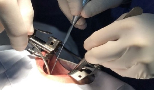 Căn bệnh khiến bé trai 8 tuổi tự cắn đứt đầu lưỡi