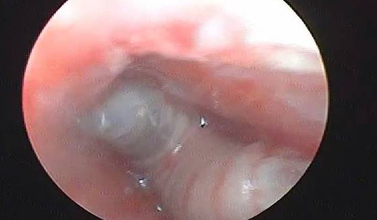 Thấy trẻ bị đau tai kèm chảy máu, gia đình đưa đi khám thì sốc nặng