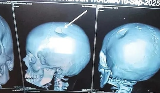 Con gái kêu đau đầu dữ dội, mẹ đưa đi chụp CT thì sốc nặng