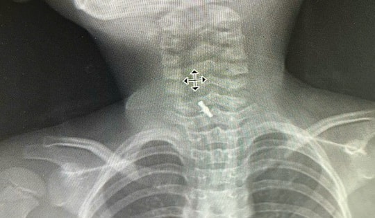 Bé gái 5 tuổi nhập viện vì đau rát họng, bác sĩ phát hiện thứ "quen thuộc" bên trong