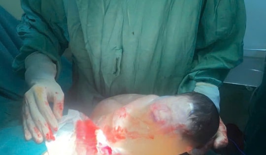 Hiếm gặp: Bé sơ sinh chào đời còn nguyên trong bọc ối
