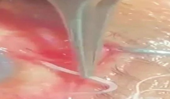 Người đàn ông 60 tuổi đau nhói ở mắt, bác sĩ sốc nặng khi phát hiện "thứ đáng sợ" bên trong