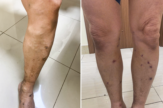 Bơm keo sinh học chữa suy giãn tĩnh mạch