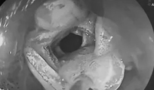 Bé gái 5 tuổi đau rát họng, bác sĩ gắp ra "thứ đáng sợ" bên trong