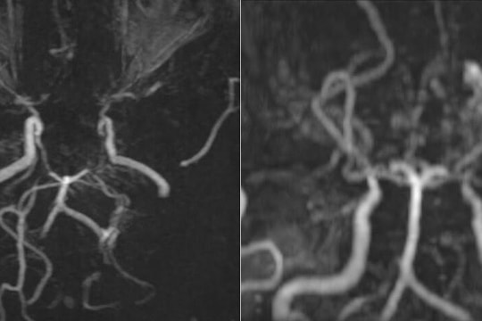 Mạch máu li ti như 'khói thuốc' trong não thiếu nữ