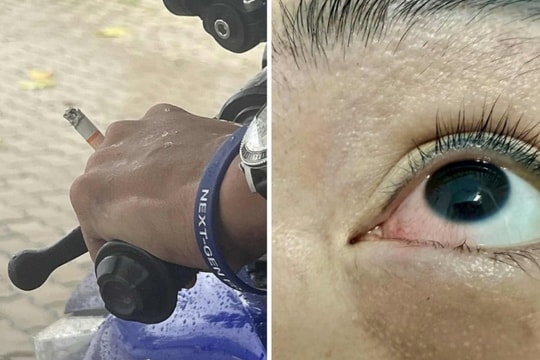 Bỏng mắt vì tàn thuốc văng trúng khi lái xe