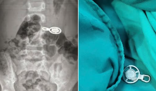 Nuốt móc khóa khi ngủ trưa, bé 4 tuổi phải nhập viện cấp cứu