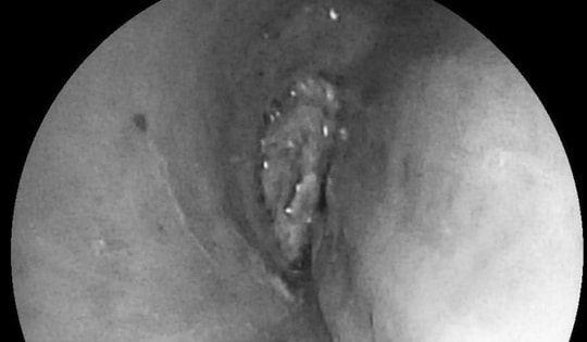 Người phụ nữ 57 tuổi bị tức ngực, bác sĩ gắp ra thứ "đáng sợ" bên trong