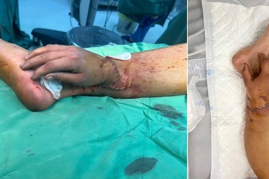 Ca ghép bàn tay vào cẳng chân của sản phụ song thai hồi phục tốt