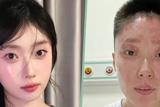 Bỏng nặng suýt mất tất cả, cựu mẫu gây sốt với nghề mới