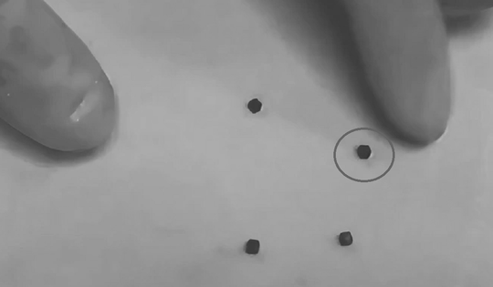 Bé trai 6 tuổi đau nhói bụng, bác sĩ gắp ra "thứ đáng sợ" bên trong