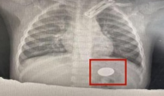 Đưa con trai đi điều trị viêm phổi, cha mẹ sốc nặng khi bác sĩ gắp ra thứ "đáng sợ" trong dạ dày