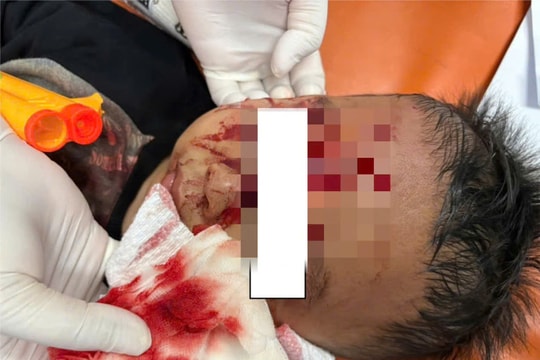 Bé trai bị chó béc-giê cắn rách mặt, bệnh viện huy động 3 chuyên khoa phẫu thuật khẩn cấp
