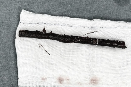 Bé gái mang nhánh cây dài 16 cm trong bụng suốt 4 tháng