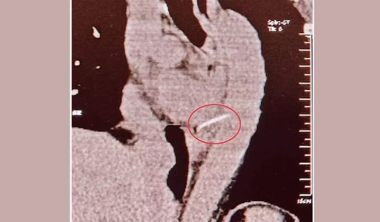 Người phụ nữ 54 tuổi đau ngực dữ dội, bác sĩ sốc nặng khi gắp ra thứ "đáng sợ" bên trong