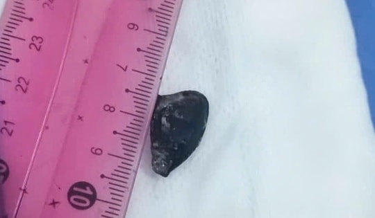 Người đàn ông ho suốt 10 năm vì… hạt sapôchê mắc trong phế quản