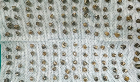 Người phụ nữ 40 tuổi đau bụng, buồn nôn, bác sĩ sốc nặng khi phát hiện "bí mật đáng sợ"