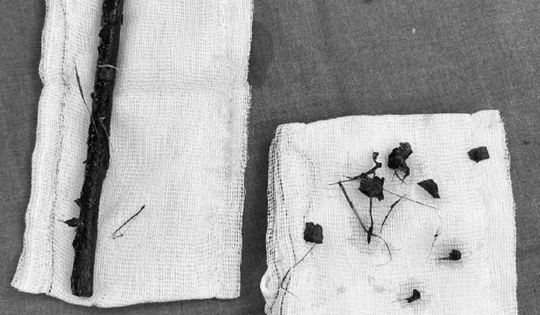 Bé gái 3 tuổi sốt cao, ho nhiều, bác sĩ sốc nặng khi gắp ra thứ "đáng sợ" bên trong