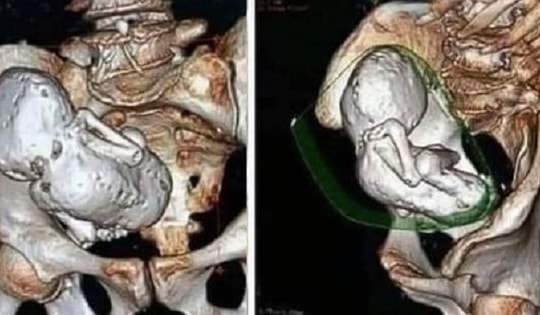 Chụp CT cho cụ bà 73 tuổi, bác sĩ sốc nặng khi phát hiện thai nhi hóa đá 30 năm