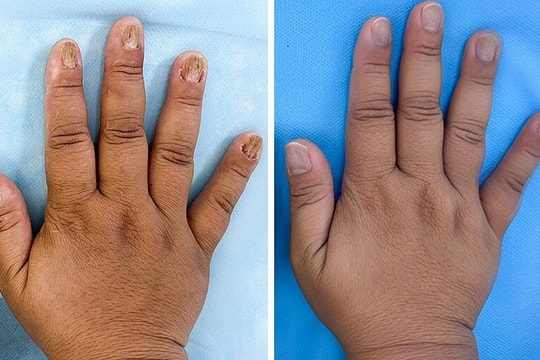 Nấm làm biến dạng móng tay chân người phụ nữ