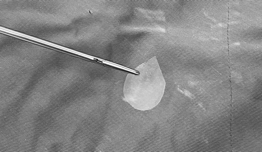 Bé trai 11 tuổi đau cổ, khó thở, bác sĩ gắp ra thứ "đáng sợ" bên trong