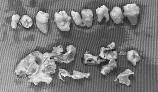 Cô gái 21 tuổi bụng to nhanh bất thường, bác sĩ lấy ra thứ "đáng sợ" bên trong