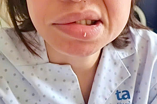 Virus zona tái hoạt động gây hội chứng Ramsay Hunt