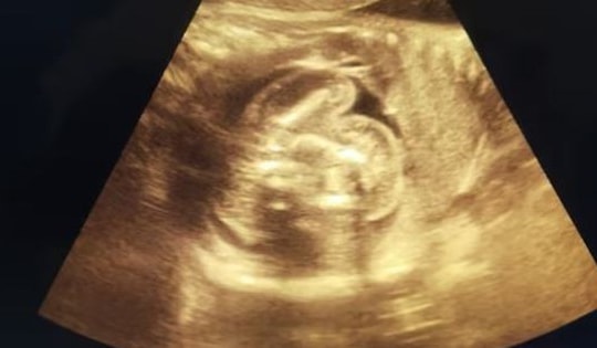 Bác sĩ sốc nặng khi phát hiện bé trai vừa chào đời đã "mang thai"