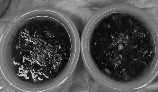 Con gái 10 tuổi kêu đau bụng suốt 3 năm, cha mẹ đưa đi kiểm tra thì sốc nặng