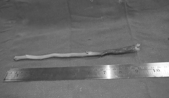 Cụ ông 80 tuổi đau họng, khó nuốt suốt 1 tuần, bác sĩ gắp ra thứ "đáng sợ" bên trong