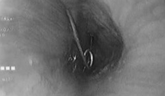 Bé 1 tuổi nhập viện trong tình trạng đau đớn, bác sĩ gắp ra thứ "đáng sợ" trong bụng